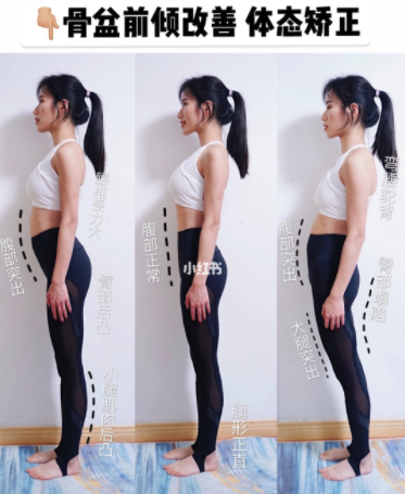 前凸後翹是假象 3招運動正盆骨