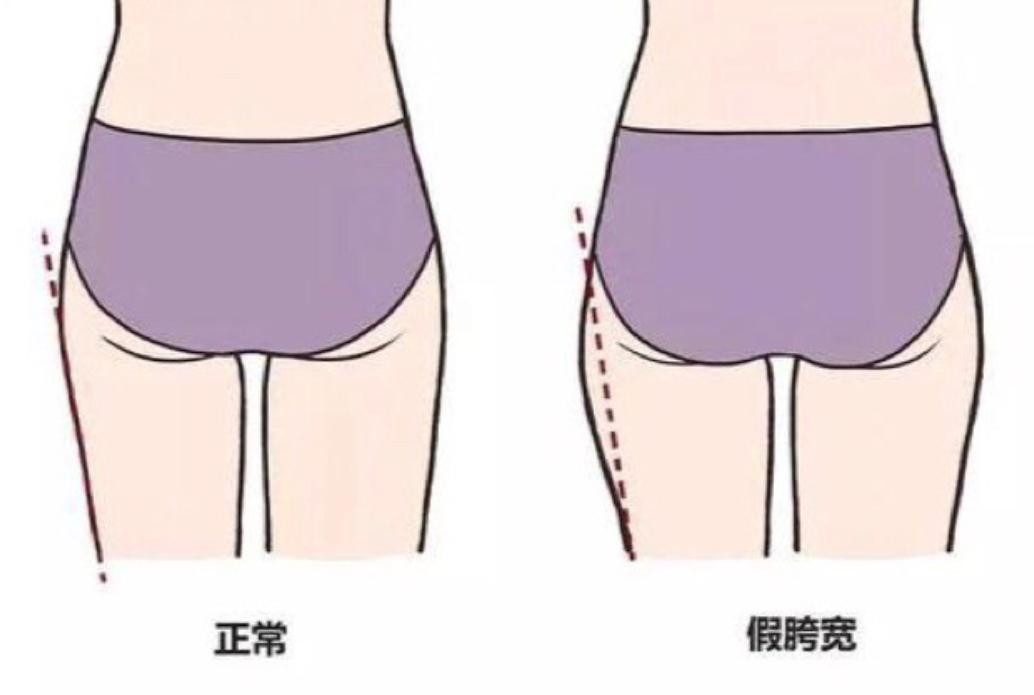 【告別五五身】「假胯寬」造成腳短、腳粗?5個動作回正骨盆 練出緊實美腿及臀部
