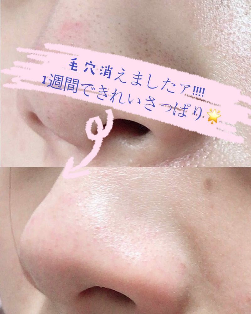 士多啤梨鼻變白滑了