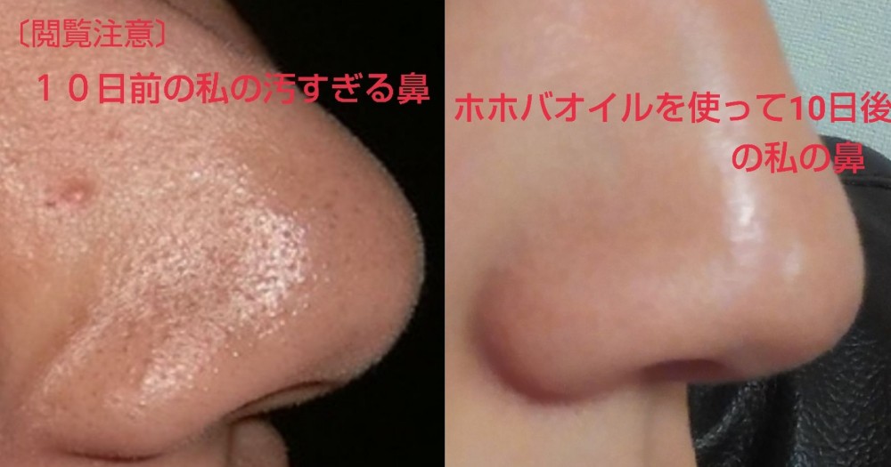 日本女生網友實測使用MUJI可可巴油黑頭粉刺立即浮出