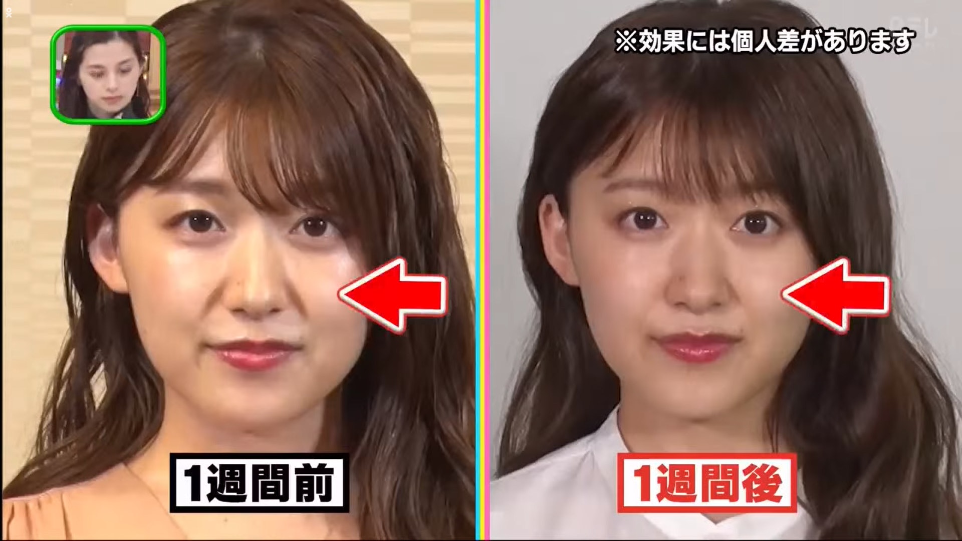 主播尾崎里紗進行一個星期按摩之後,浮腫情況有改善,法令紋減淡了很多。