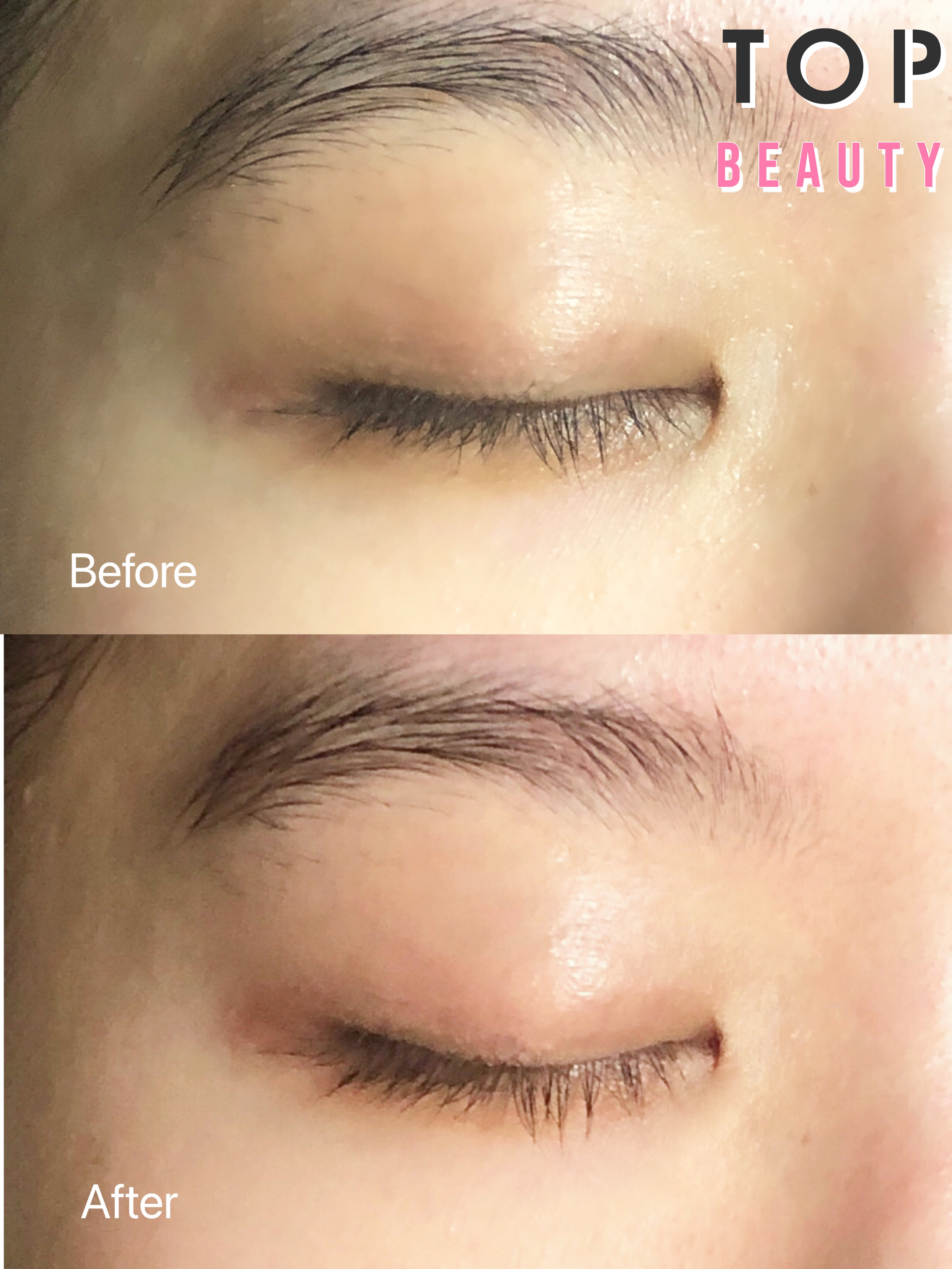 Evie BeautéMRF電眼小熨斗療程前後效果。