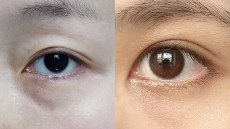 隨著年齡增長,皮下脂肪日漸萎縮及皮膚老化,失去彈性而下垂,使下眼皮內側的淚溝變得很明顯。