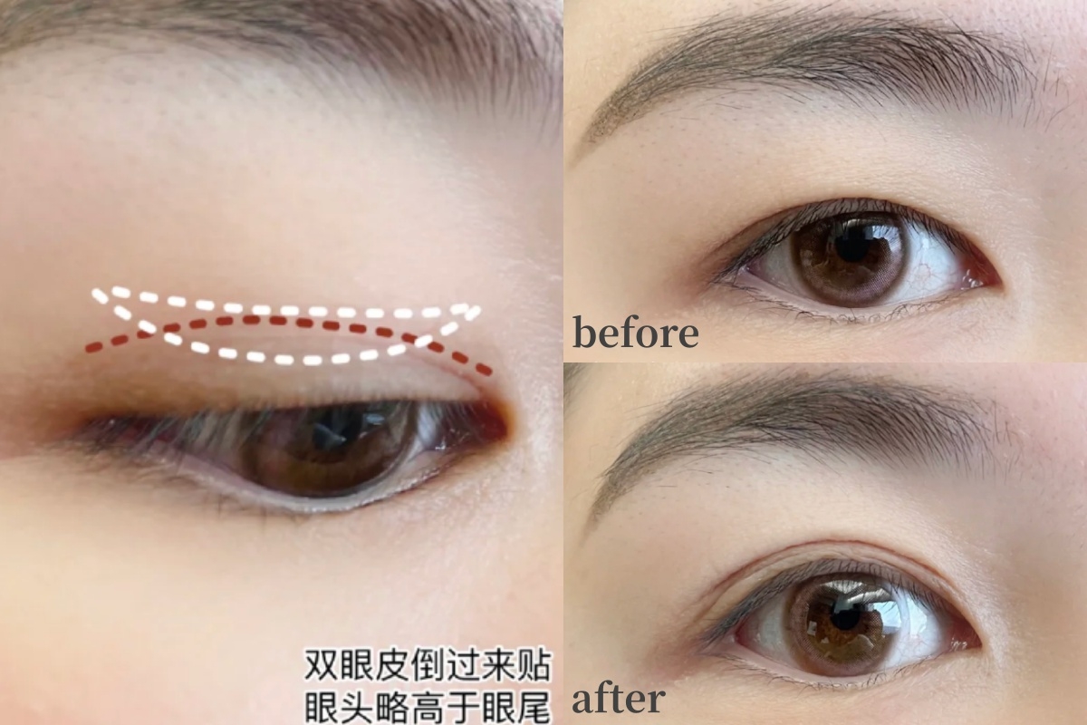 金魚泡泡眼可以使用新月形的雙眼皮貼