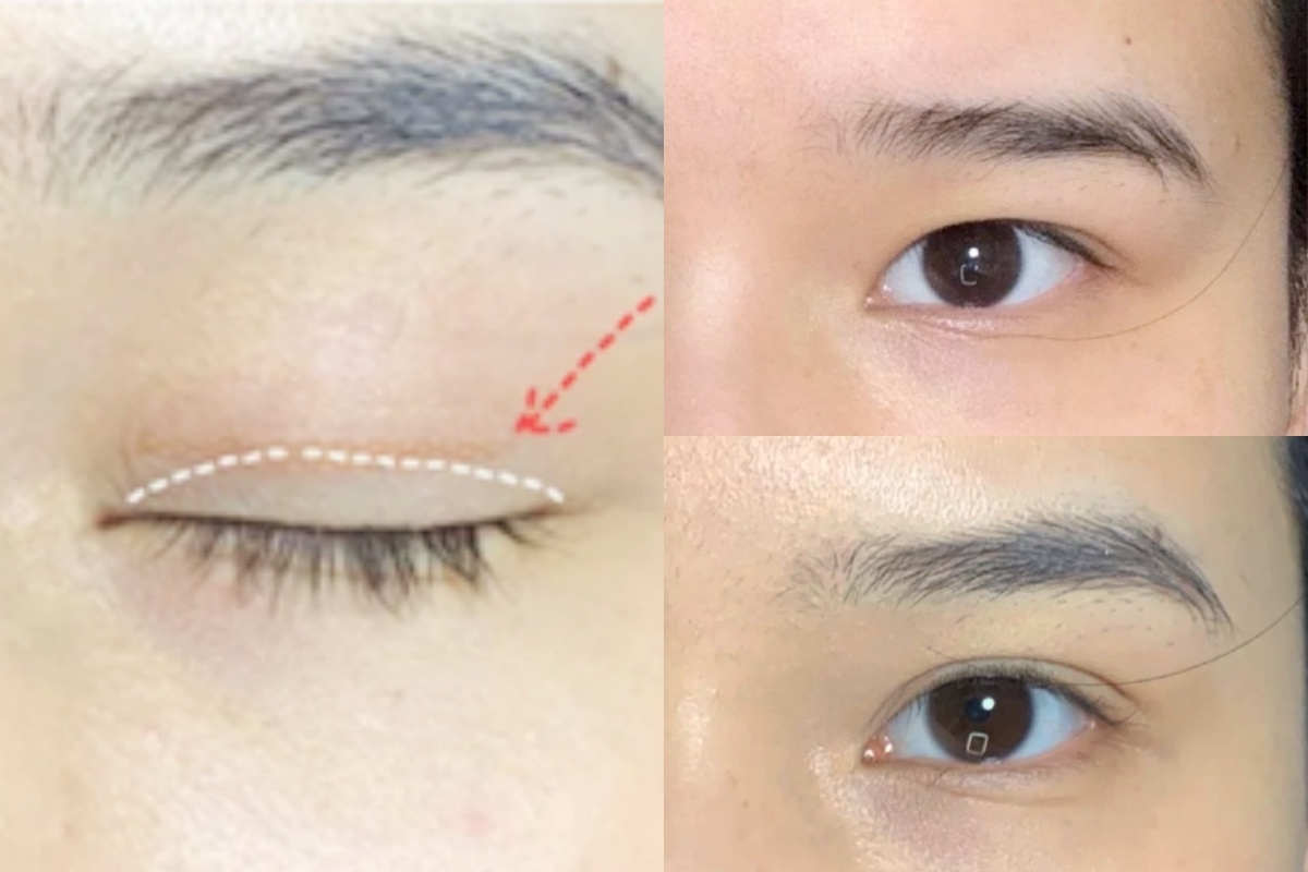 蒙古摺雙眼皮建議選擇細款的橄欖形雙眼皮貼