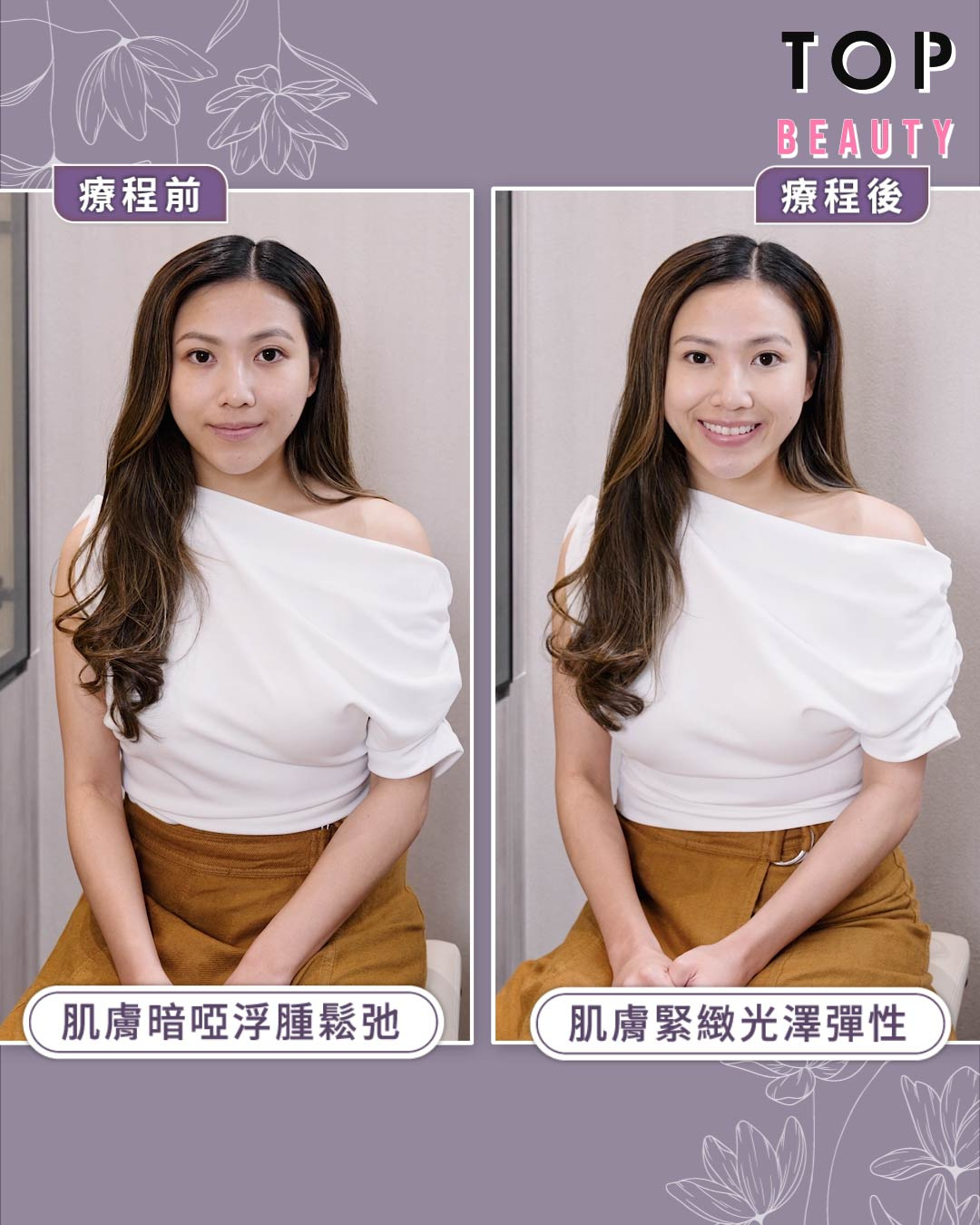療程後,V臉效果超明顯,連蘋果肌都變得緊緻飽滿。