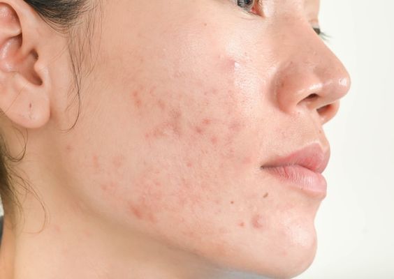 肌膚容易出汗出油開始冒出令人討厭的暗瘡