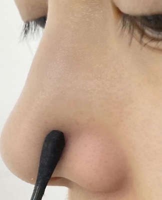 當毛孔擴張後,建議使用青春棒輕壓粉刺清除,注意力道不能過大,否則會傷害肌膚。