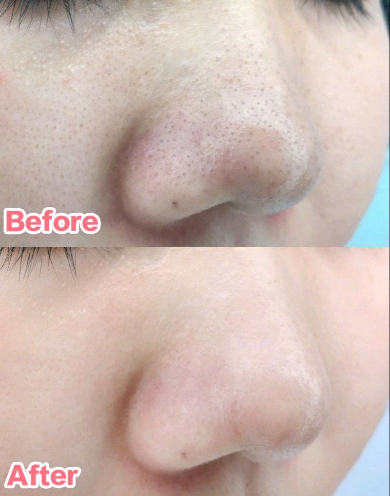 網民實測熱敷法黑頭明顯變少,毛孔亦有所改善。