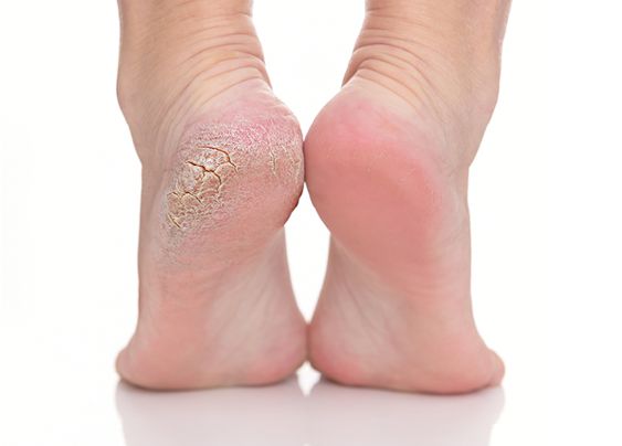 NG習慣釀腳跟龜裂三、胡亂去死皮