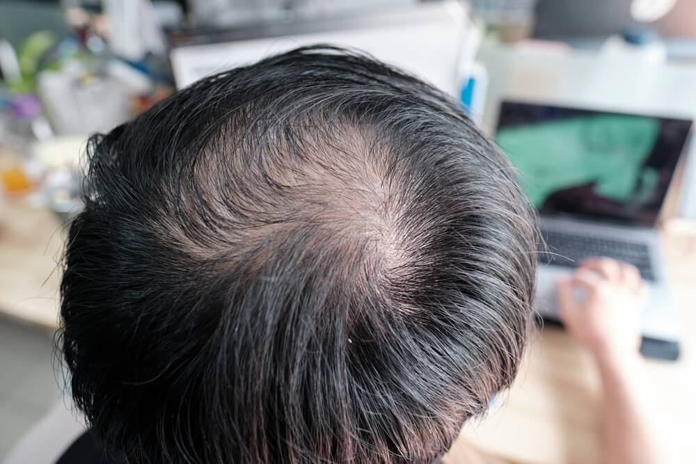 男人一到30歲就開始變禿頭。