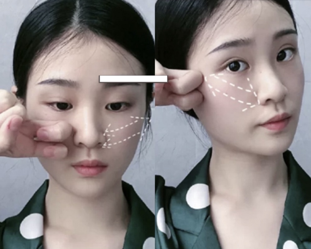 二、顴骨提拉有減齡感