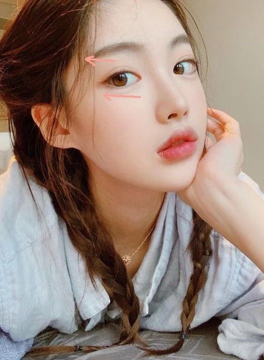 淚溝消除法2、Y型提拉眼周肌膚