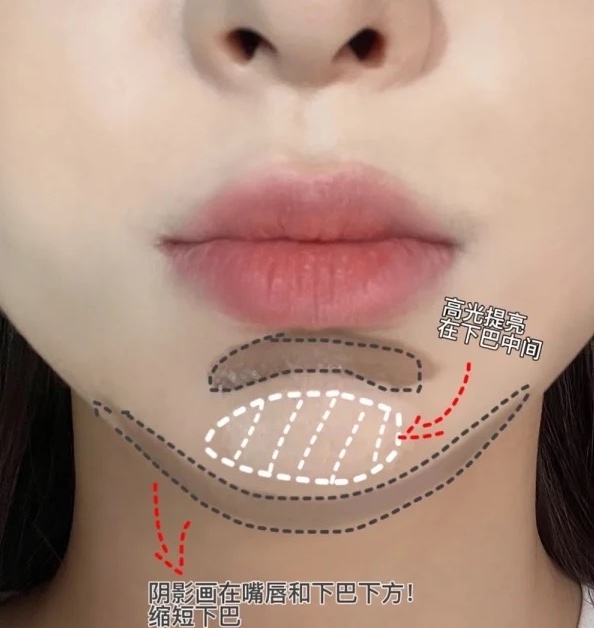 下巴修容術三、長下巴變短