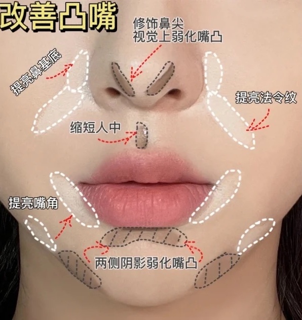 下巴修容術一、改善嘴突