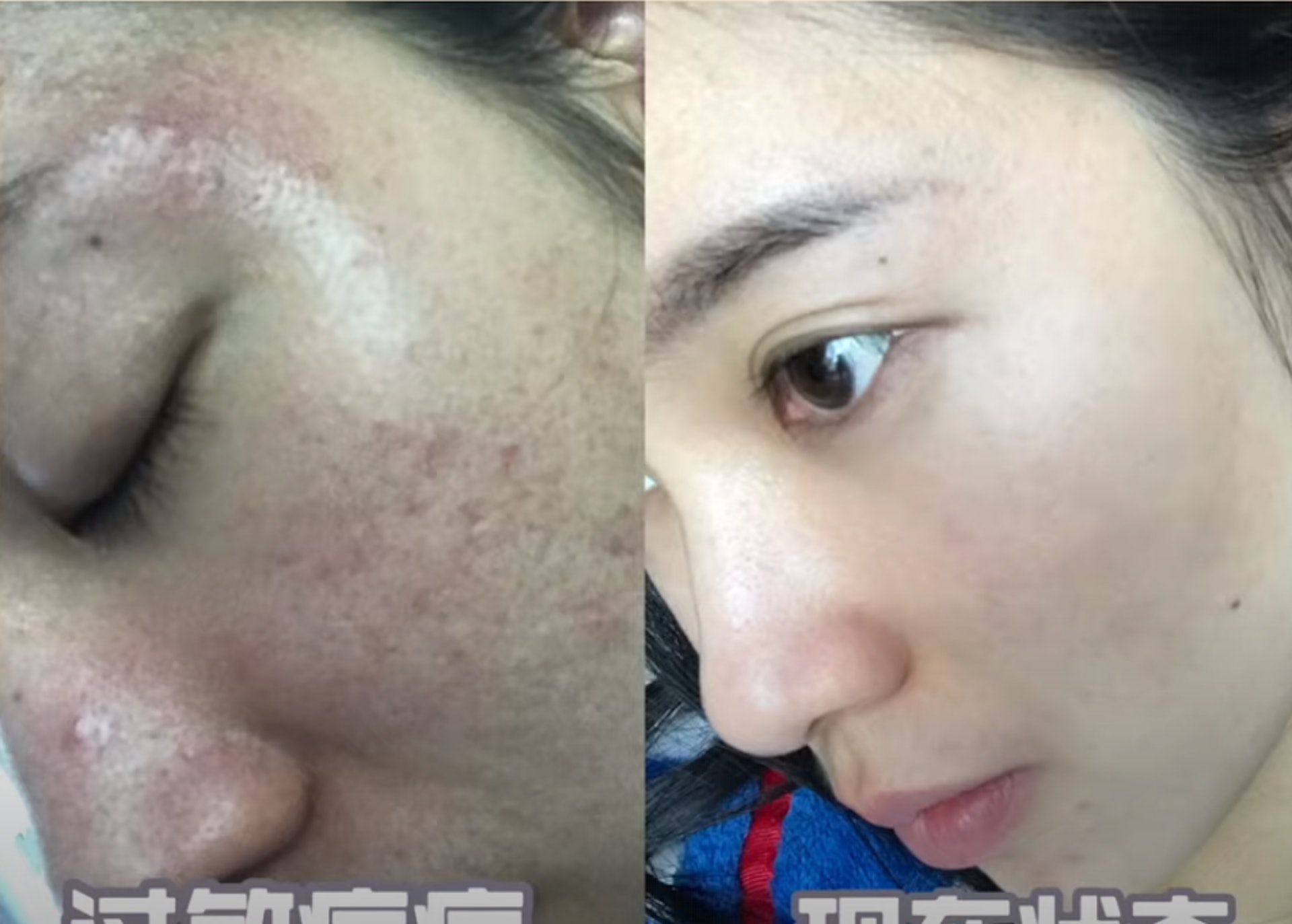 過敏痕癢VS現在狀態。