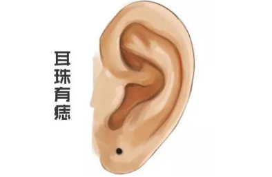 耳垂上有痣代表著聰明孝順、心地善良,經常有好運光顧!