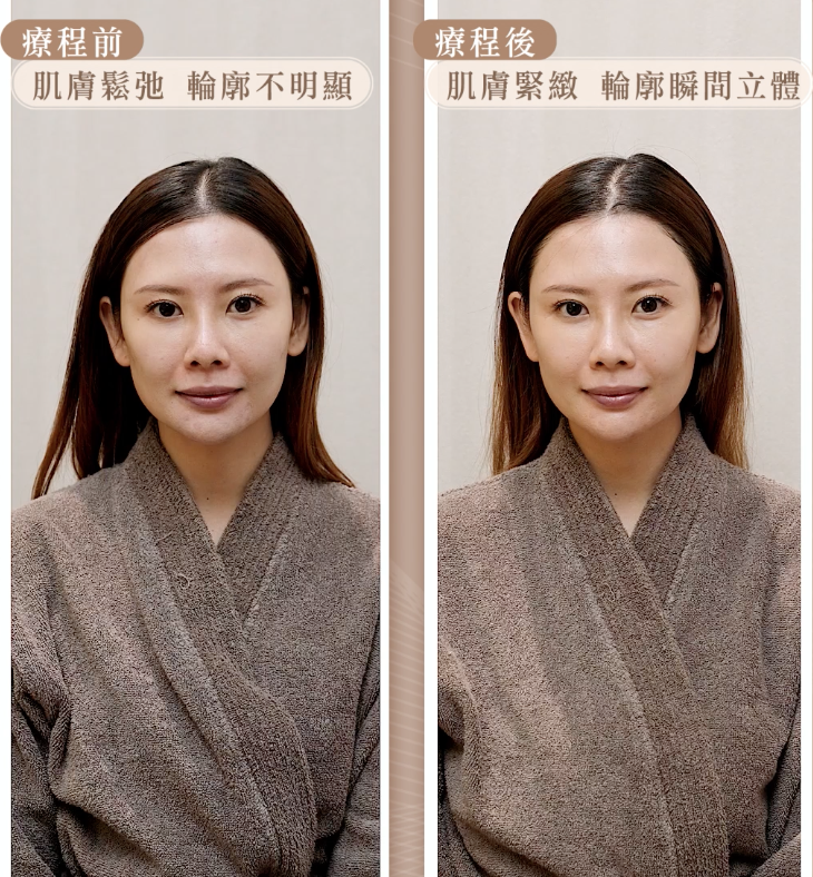 做完療程後，肌膚即時水潤「漲卜卜」，就連蘋果肌都變得飽滿。 