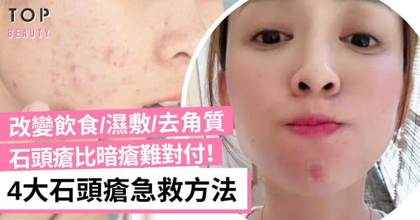 紅腫發炎石頭瘡比暗瘡難對付！4大石頭瘡急救方法 放膿放血就可以消除？