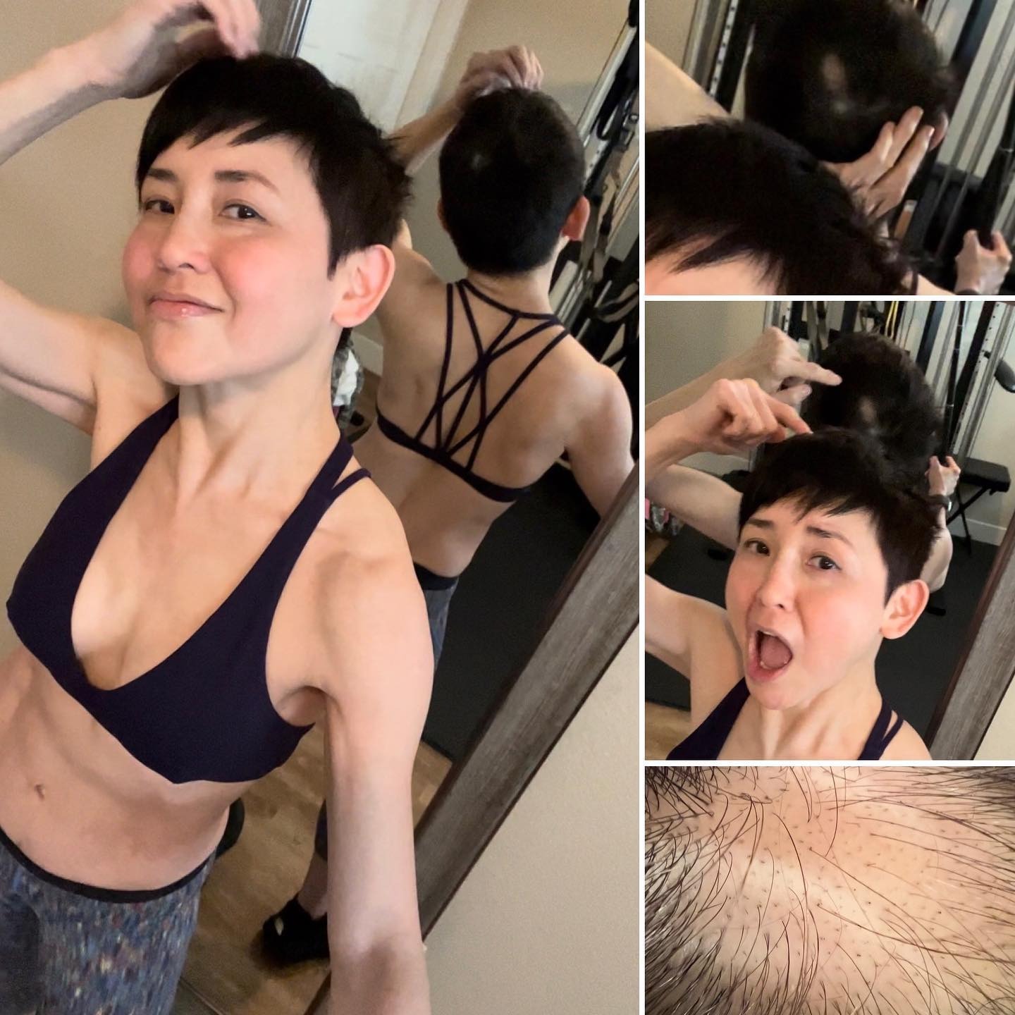 劉美君曾患鬼剃頭