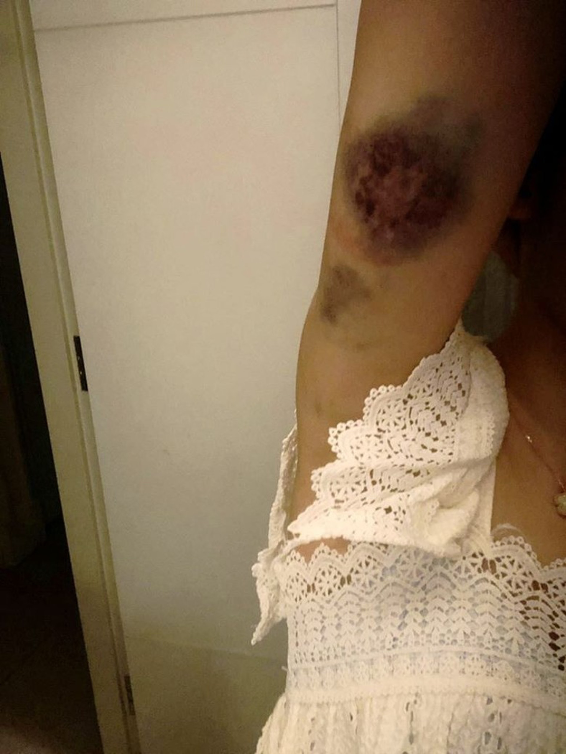 當年楊埕被男友動手後，曾在社交平台post一張手部瘀傷的照片，不過就未知是否因為前男友而弄傷。