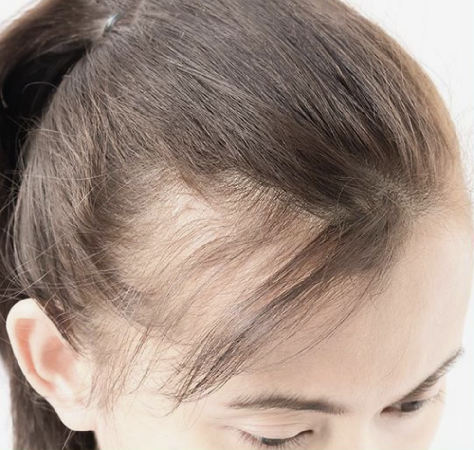 不少女生都喜歡紮馬尾，清爽方便，但長期將頭髮綁起，並用髮圈牢牢固定。