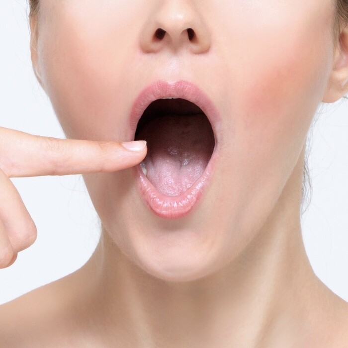 口腔中的細菌帶有酸性物質,容易破壞口腔黏膜,導致痱滋產生。