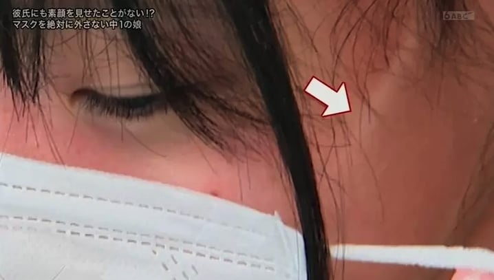 就算回到家中,她也是戴著口罩才會有安全感,而由於她長時間佩戴口罩,導致臉上出現了明顯的口罩痕。