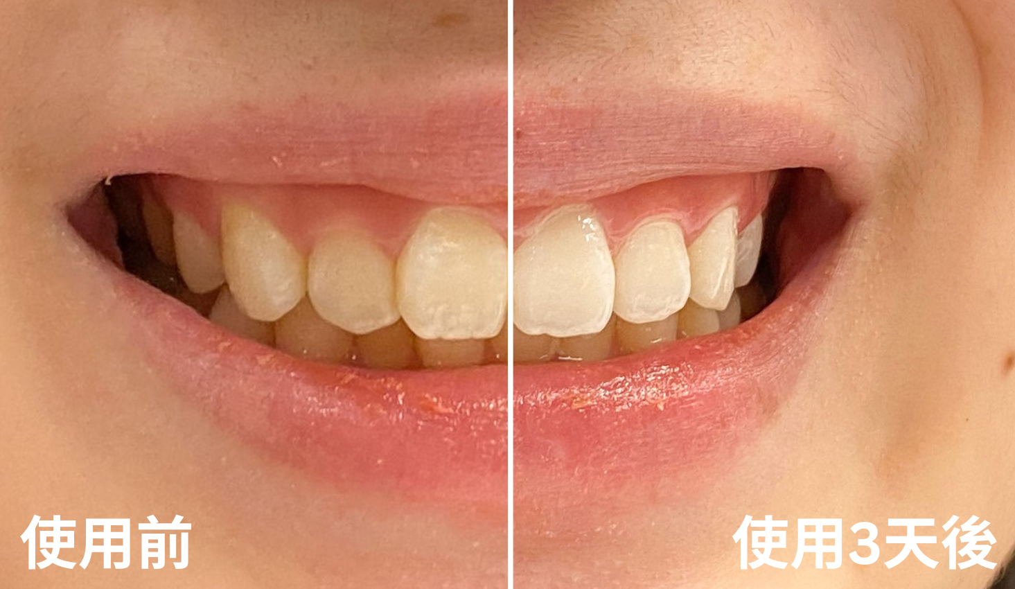 3日後就察覺到牙齒明顯變得亮白。