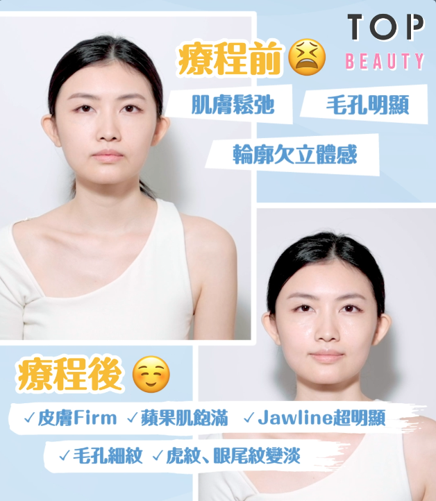 完成療程後，無論輪廓、膚質都有很明顯的改善。