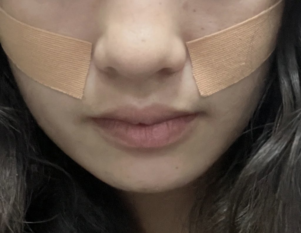 將運動肌肉貼貼在法令紋的位置,持續一段時間就可以見到法令紋被淡化了。