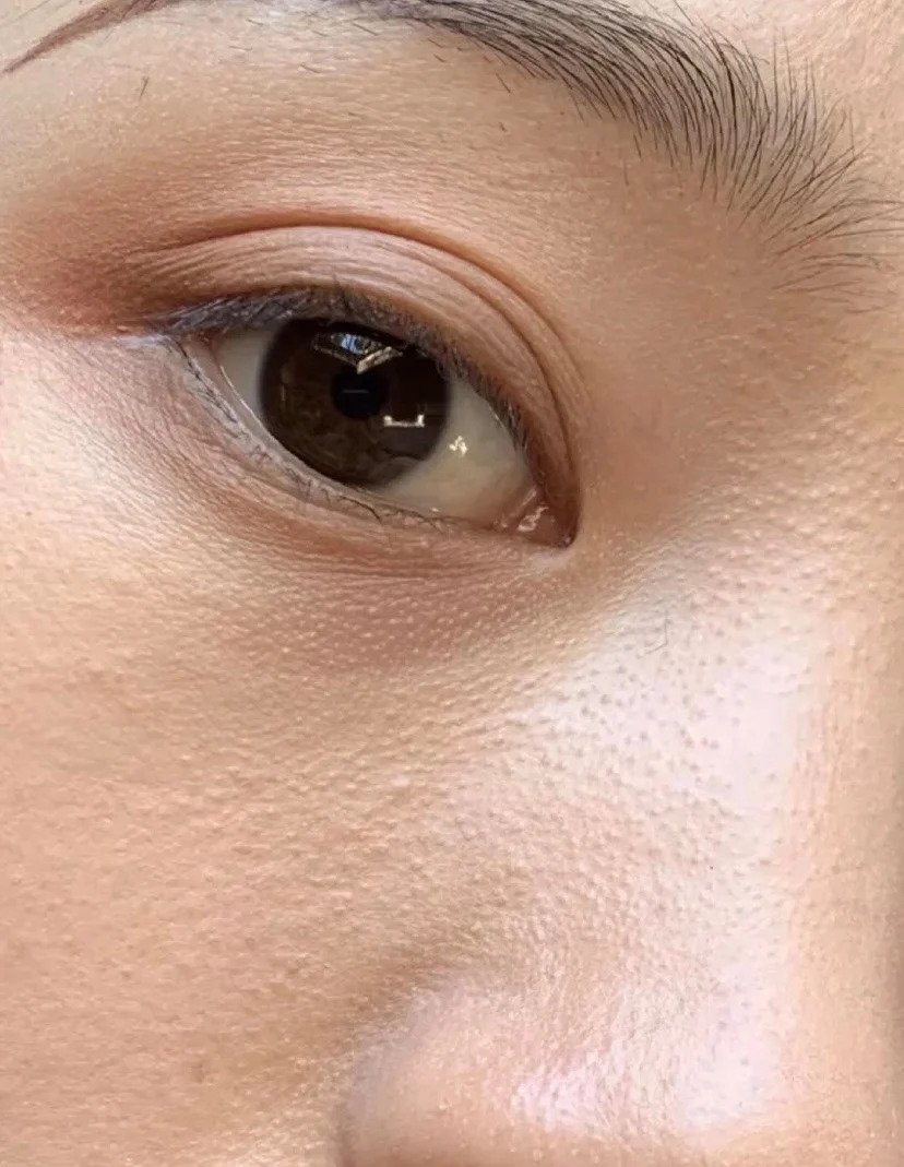 眼周下一粒粒凸起的皮膚就是毛囊角化(毛周角化)