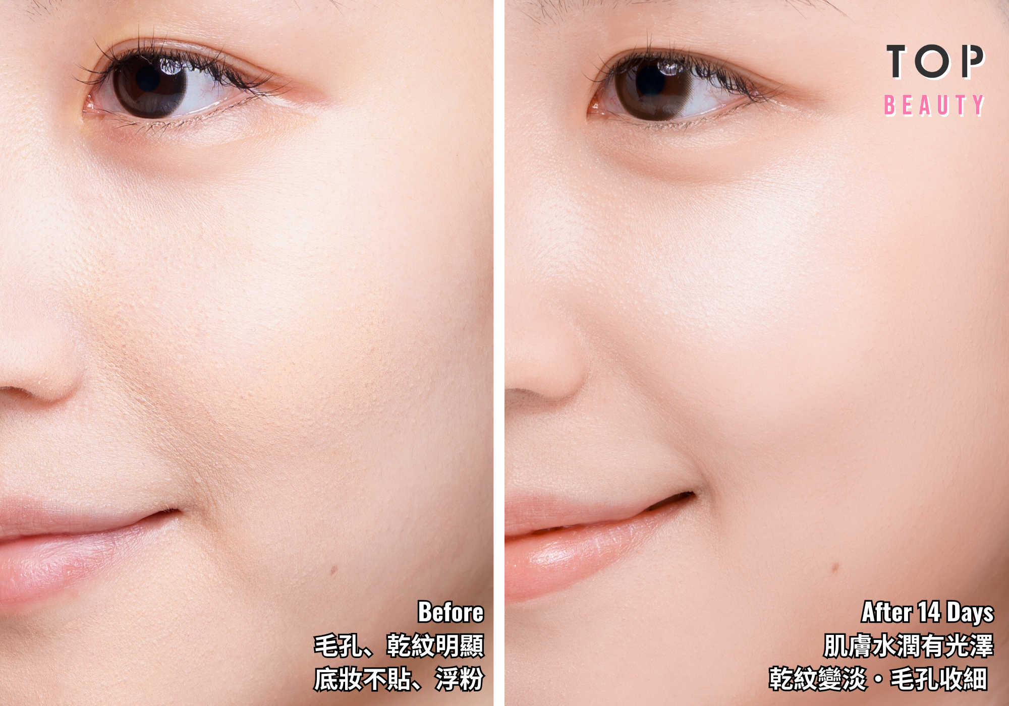 看看Carrie的真「Before And After」！Belotero® Revive水光針效果一清二楚！（療程效果因人而異）