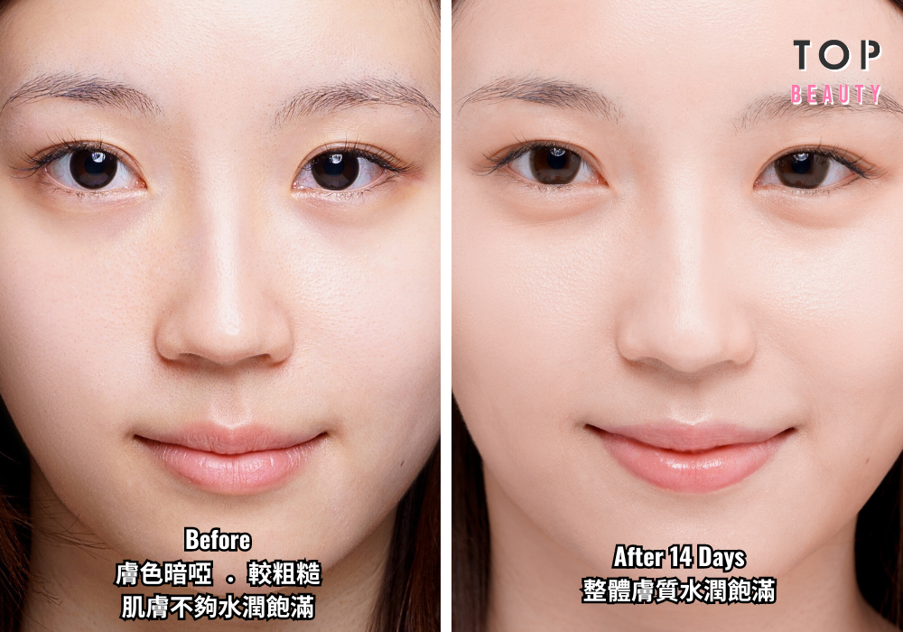 Belotero® Revive水光針後，Carrie整體膚質得到明顯提升，更細緻、更水潤、更光澤。（療程效果因人而異）