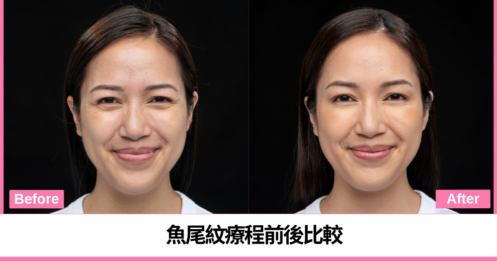 接受XEOMIN®療程前後魚尾紋比較，療程效果因人而異。