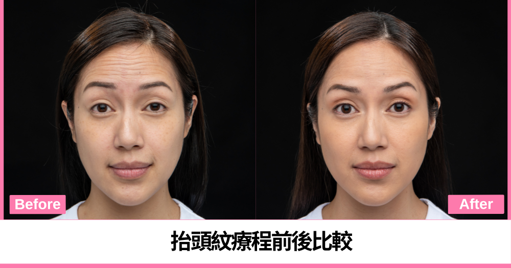 接受XEOMIN®療程前後抬頭紋比較，療程效果因人而異。