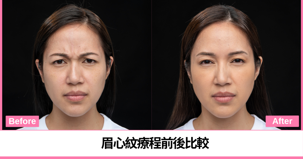接受XEOMIN®療程前後眉心紋比較，療程效果因人而異。