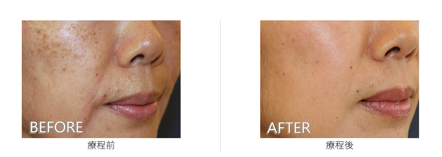 PICO皮秒激光前後對比照。