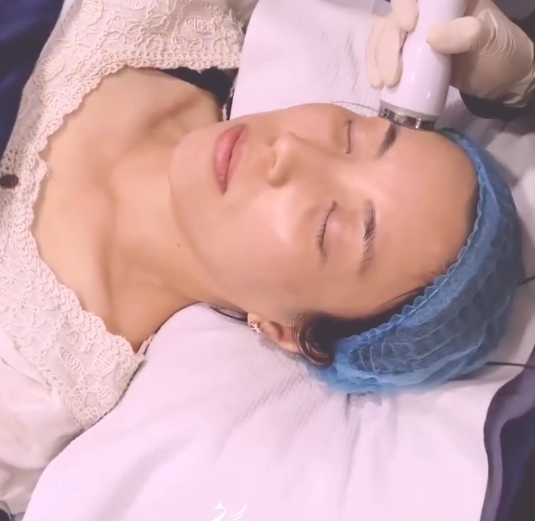 Excel V+ 血管激光 - Beaunique Medical Aesthetics