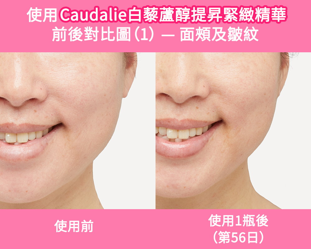 香港用家使用Caudalie膠原精華1瓶（56日）後，蘋果肌緊緻提升，法令紋也明顯減淡了。