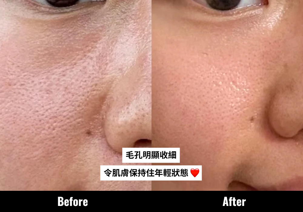  CLARINS全新第9代Double Serum改善了Chole的毛孔問題。