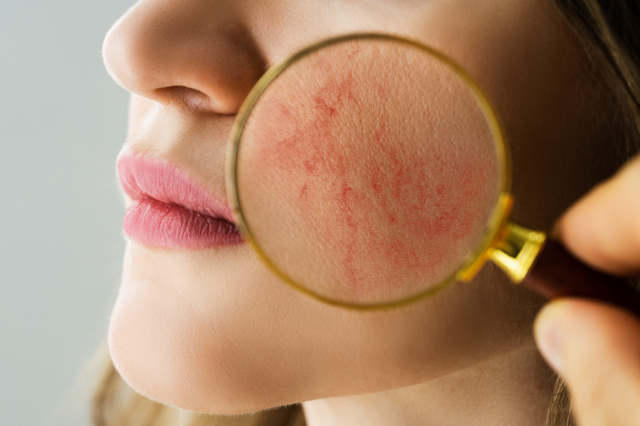 玫瑰痤瘡(Rosacea)是一種常見的慢性皮膚問題,多影響20歲以上女性,尤其是亞洲人。