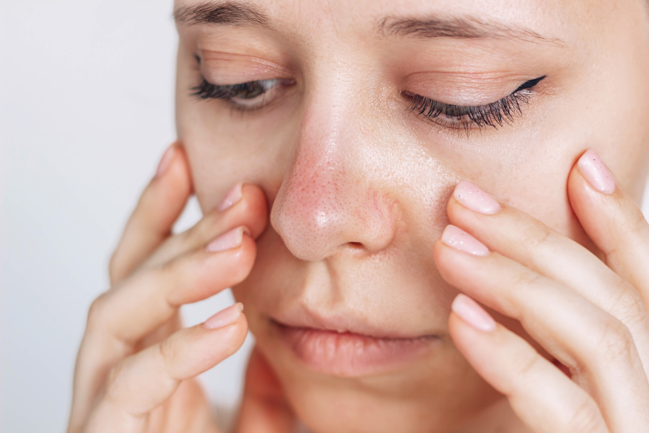 部分患者鼻子會因充血腫大,稱為「酒糟鼻」(rhinophyma)。