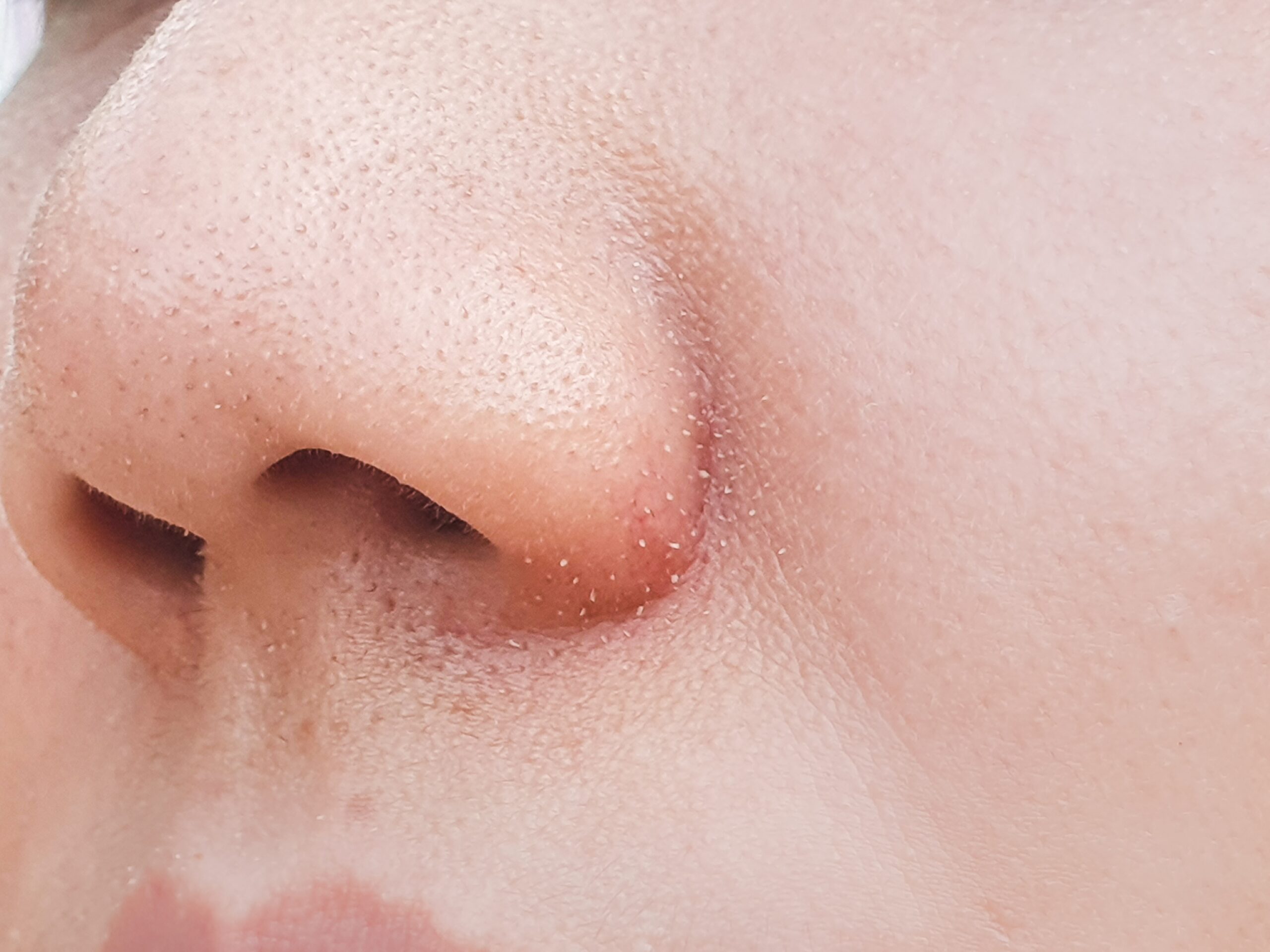 黑頭粉刺很多主要是因為毛孔被油脂、老廢角質和污垢堵住，然後接觸空氣後氧化變黑，特別是T字部位（額頭、鼻翼和下巴）最容易出現～