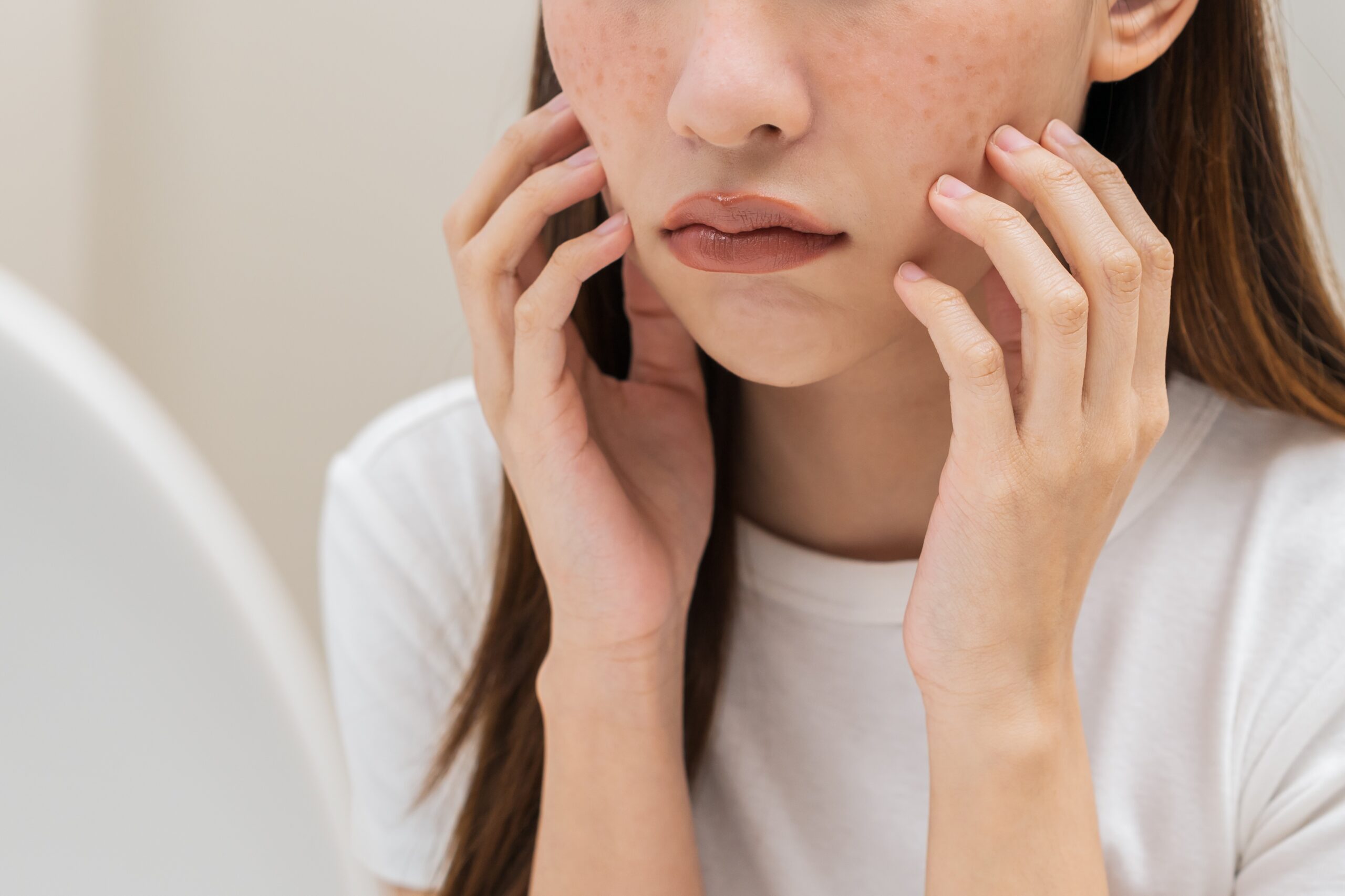 色斑是皮膚上因為黑色素沉澱形成的斑點,顏色從淺咖啡色、深褐色到帶點紅色都有。