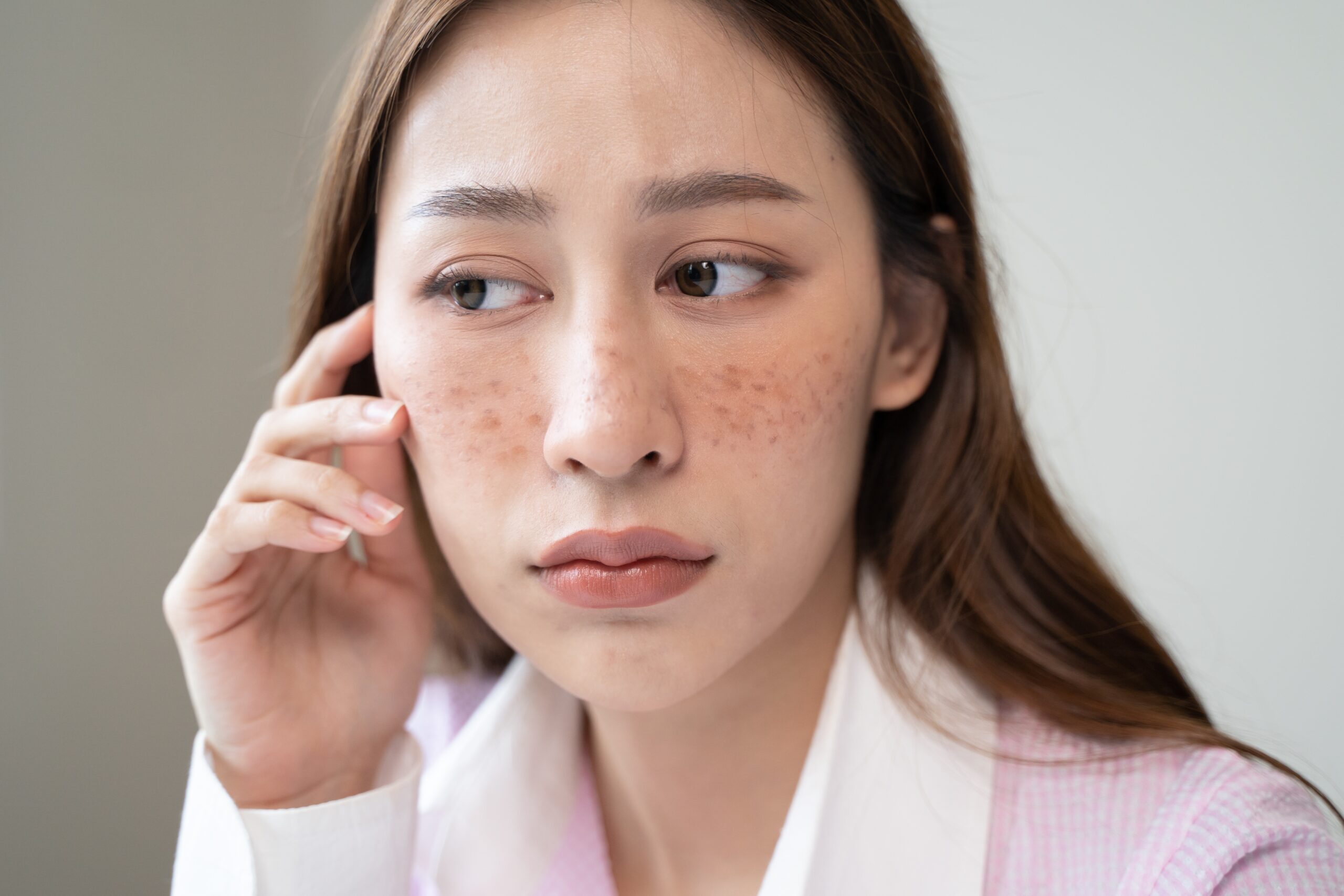 色斑不只有一種,每種的樣貌和成因各不相同,大致可分為淺層色斑和深層色斑。