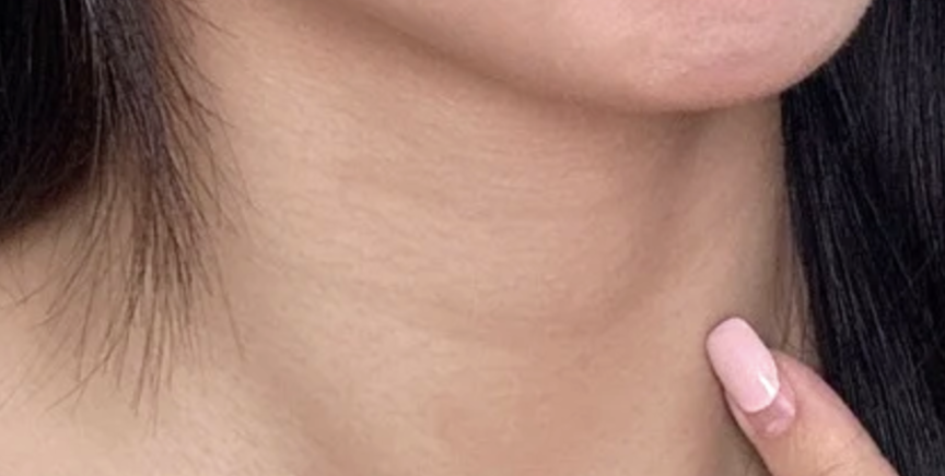 開始第1天的頸部護理乳液測試,頸上明顯看到2條頸紋。