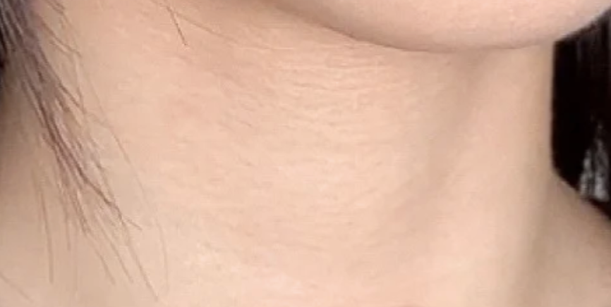 7天頸紋淡化效果顯著!不過以肉眼仔細觀察,仍可以看出淺淡紋路。