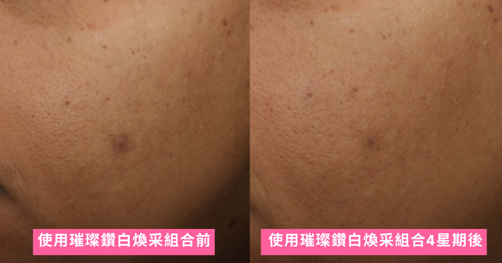 91%用家⁴表示，只需持續使用璀璨鑽白煥采組合4星期，就能淡化色斑。