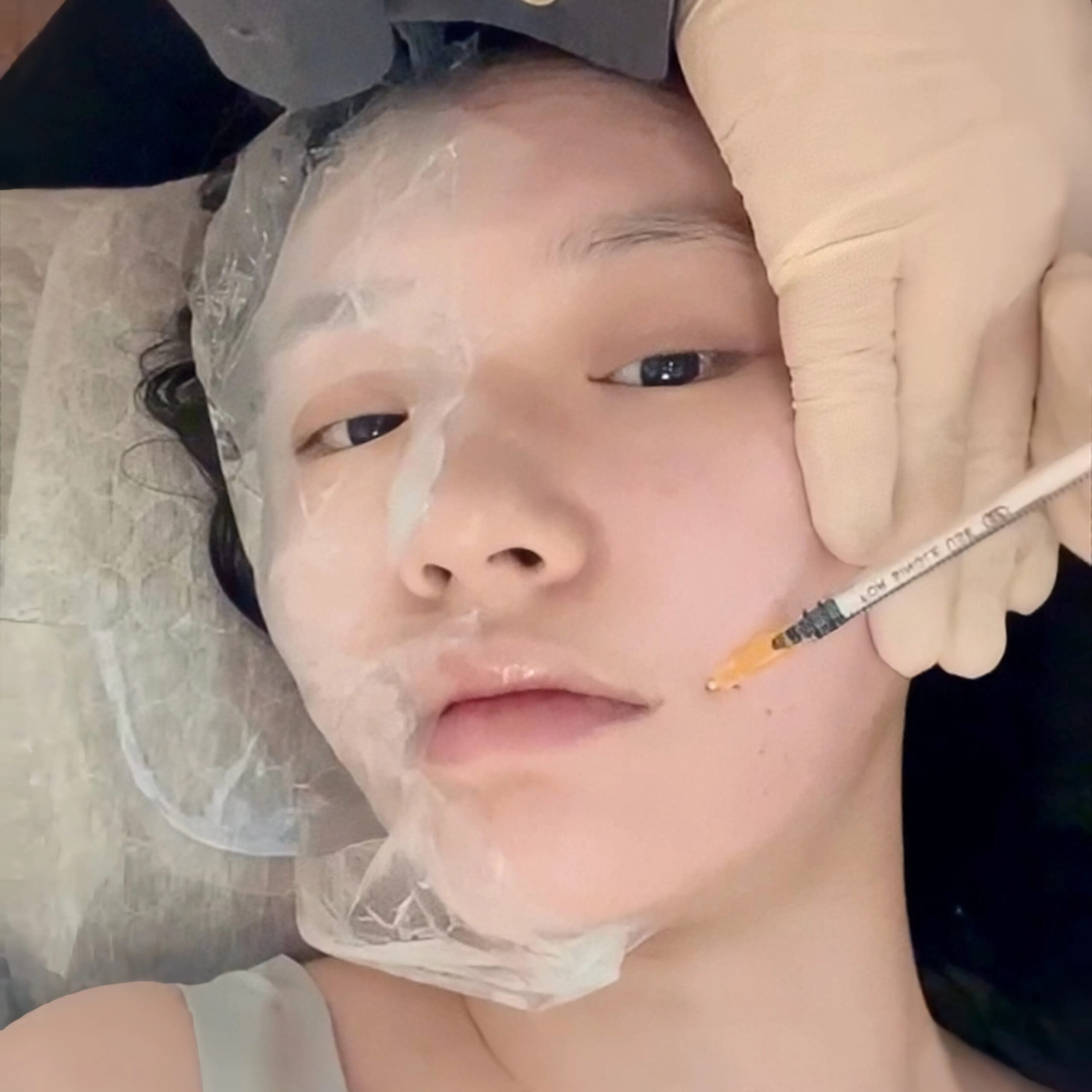 林允做的人工注射型水光針,效果更明顯。